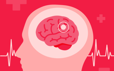 Protecting Your Brain: Strategies for Preventing Strokes